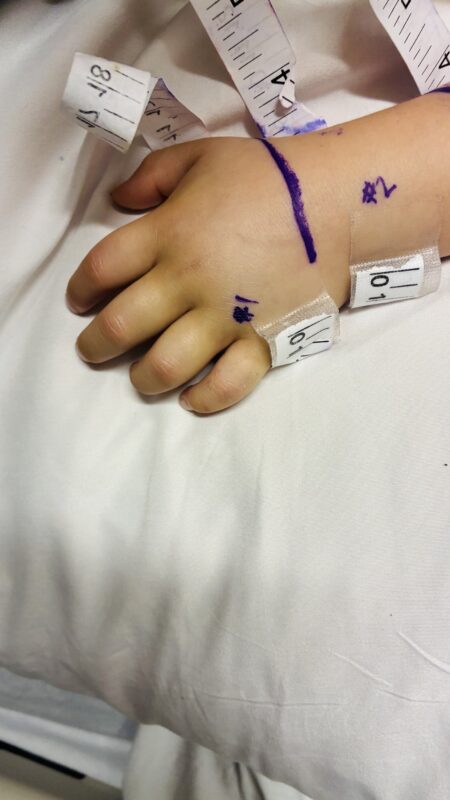 Adeline Barajas' hand. Photo courtesy of Manny Barajas.